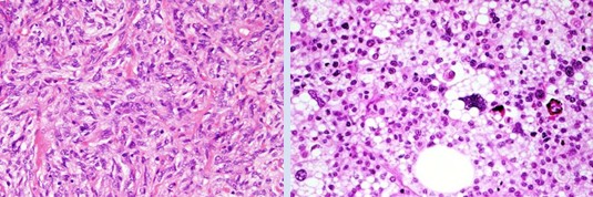 UPDATE IN SOFT TISSUE AND BONE PATHOLOGY