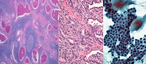 UPDATE IN HEAD AND NECK PATHOLOGY: Surgical Pathology of thyroid gland and salivary gland cytology and histological correlation